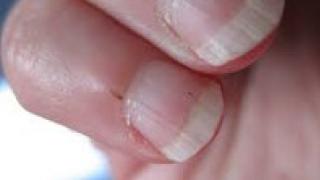 Заусенцы на пальцах, причины появления, удаление, лечение, профилактика Почему образуются заусенцы на пальцах рук